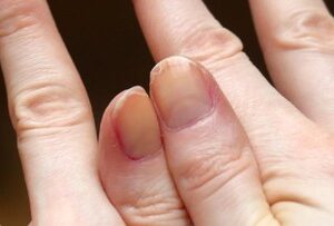 7 Tanda Masalah Kesehatan yang Terlihat dari Kuku