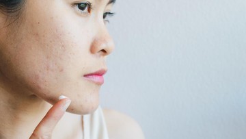 7 Jenis Makanan yang Dapat Memperparah Jerawat dan Harus Dibatasi